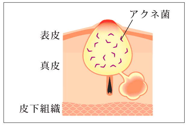 毛穴が詰まってニキビができているイメージのイラスト